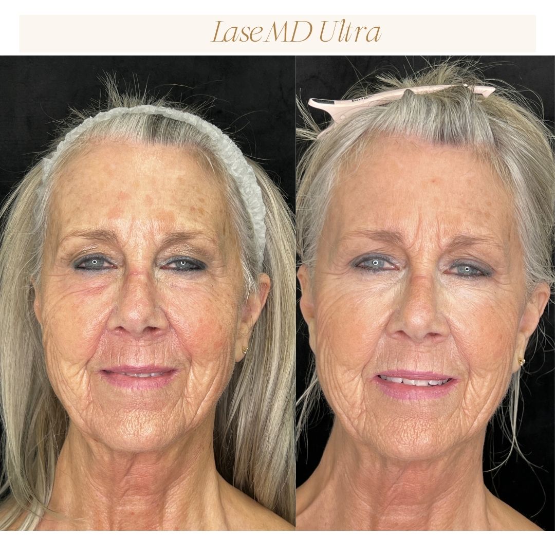 Before and After Image: LaseMD Ultra