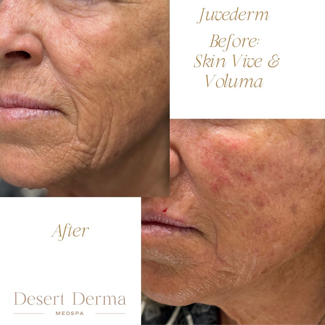 Before and After Image: Skin Vive, Voluma Cheeks - left-front-oblique