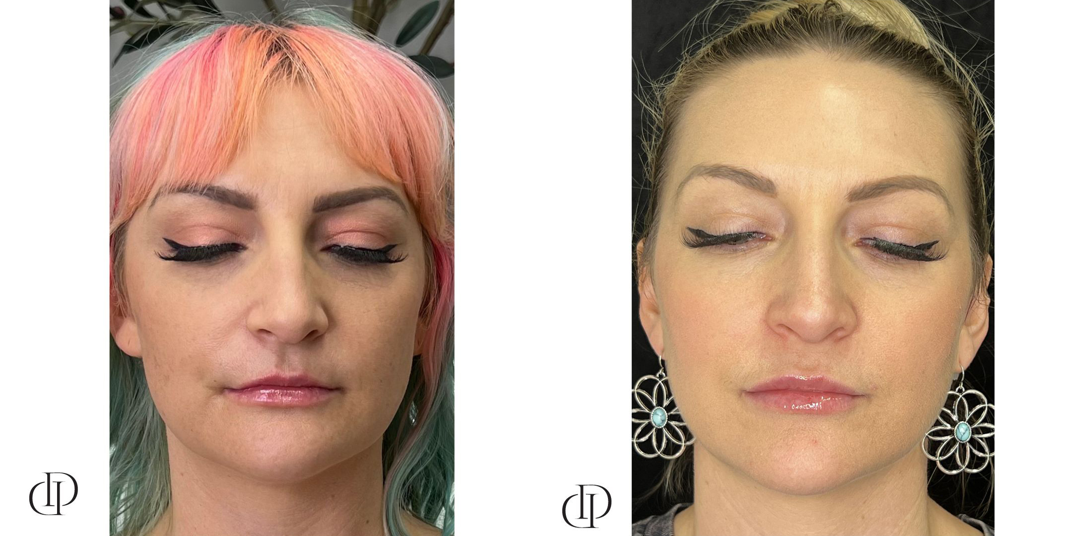 Before and After Image: Lips & Laser Skin Resurfacing - front